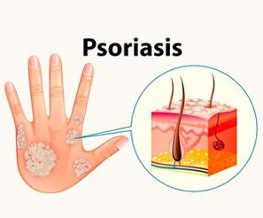 Какво представлява псориазисът и защо е опасен 